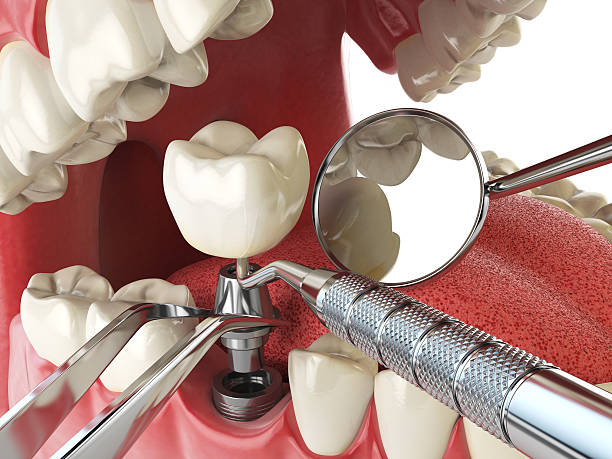 Best Emergency Dental Care for Broken or Chipped Teeth in USA